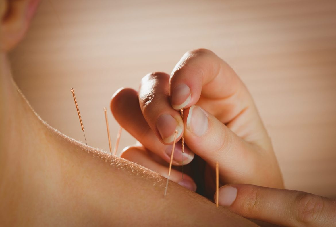 Acupuncture: Heal Your Body with Ancient Chinese Therapy