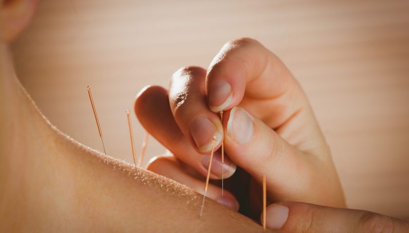 Acupuncture: Heal Your Body with Ancient Chinese Therapy