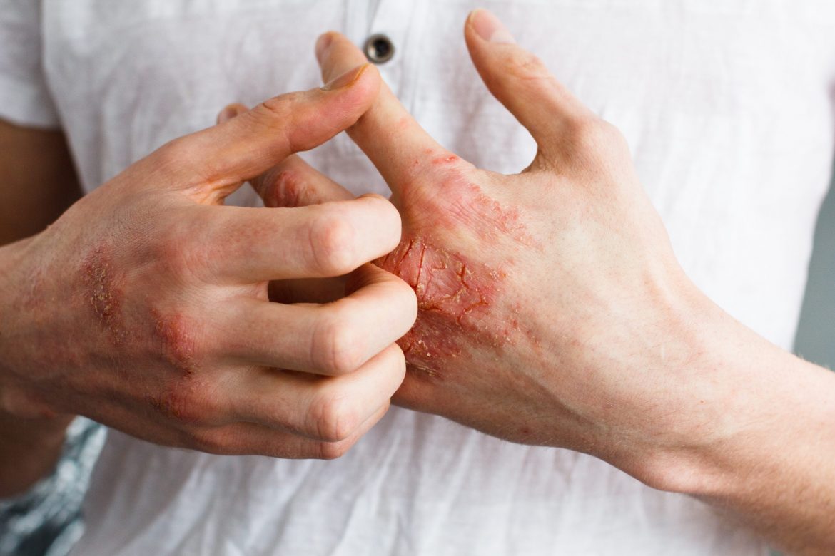 How to fight eczema in winters How to fight eczema in winters