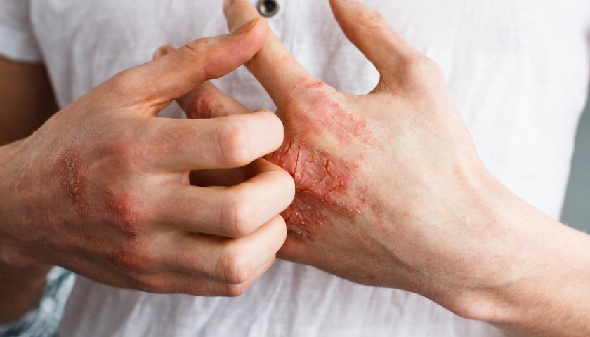 How to fight eczema in winters