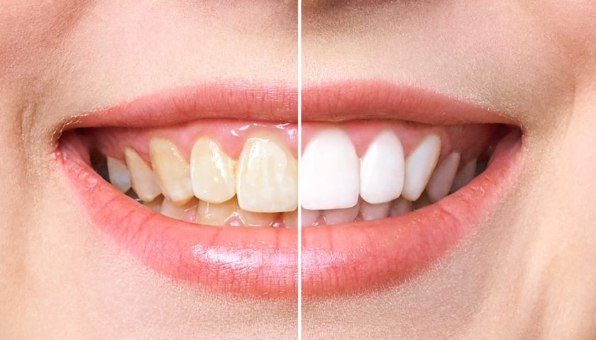 Natural Ways to Whiten your Teeth