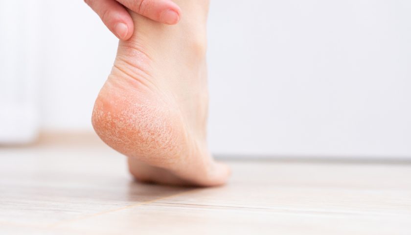 Cracked Heels