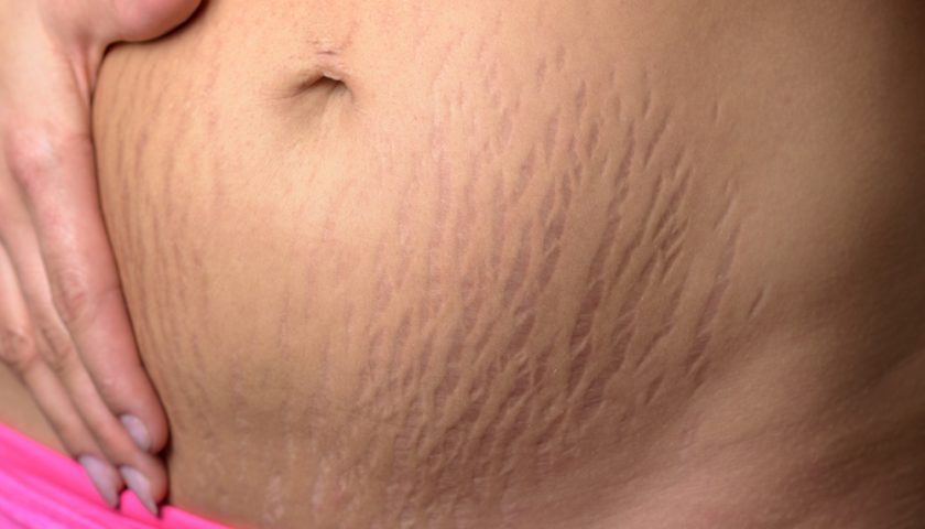 Cellulite VS Stretch Marks