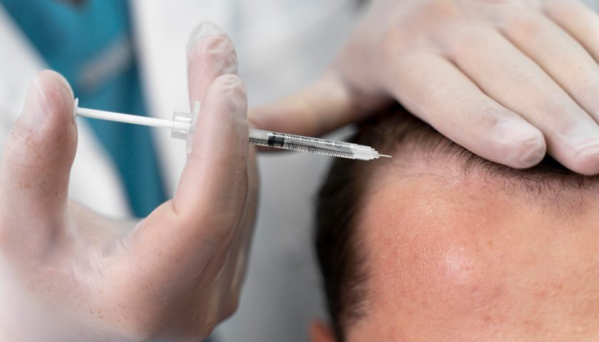 PRP hair treatment