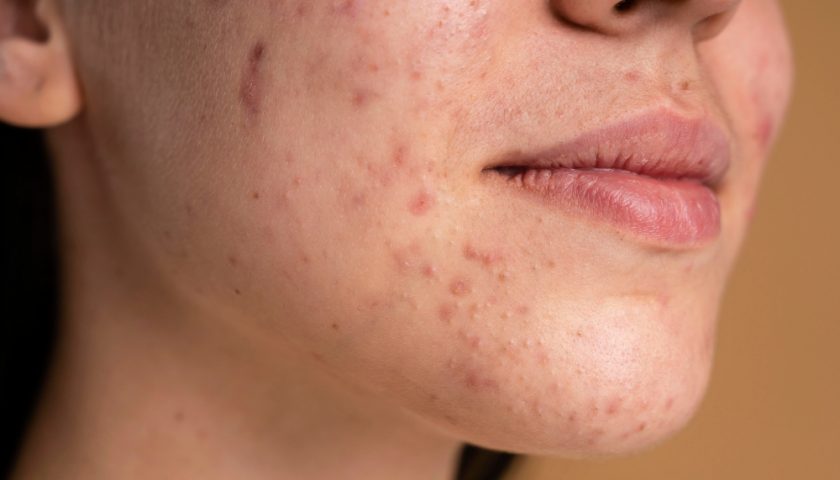 Acne Scars