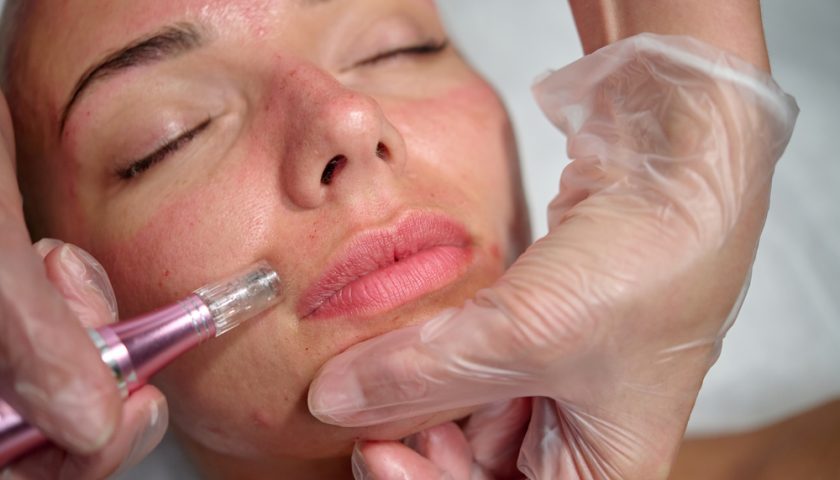 Microneedling