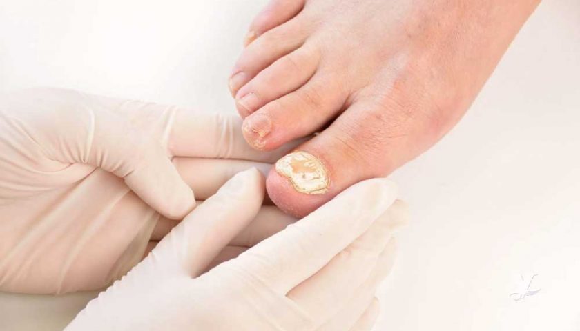 Remedies to Treat Toenail Fungus