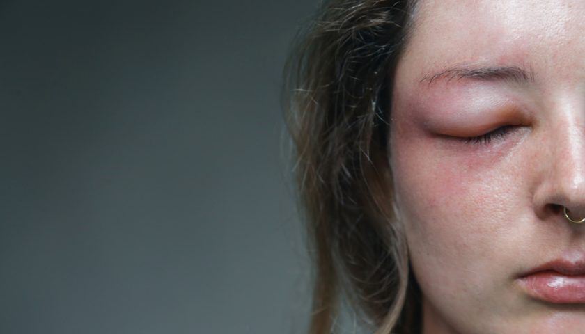 How to Reduce Face Swelling