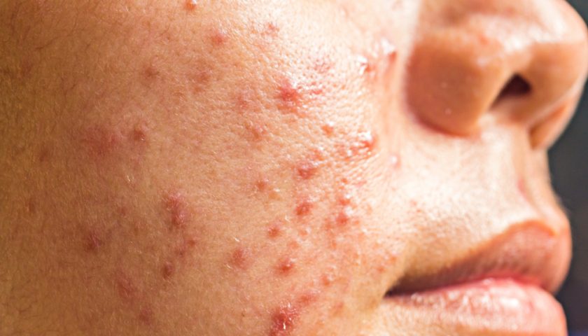 Get Rid of Cystic Acne