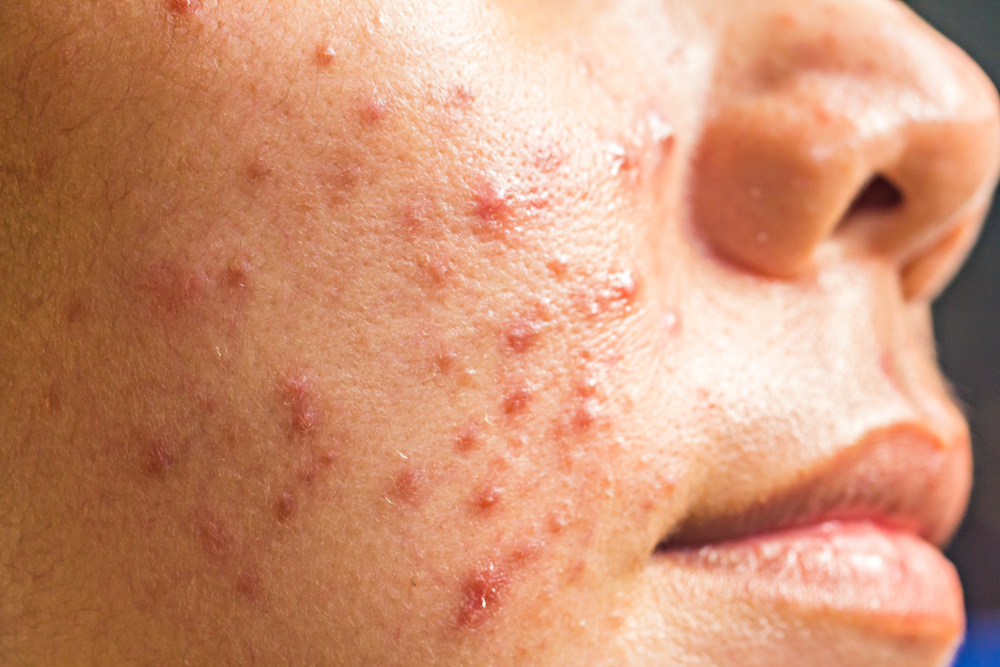 A Complete Guide On How To Get Rid Of Cystic Acne Healthwire