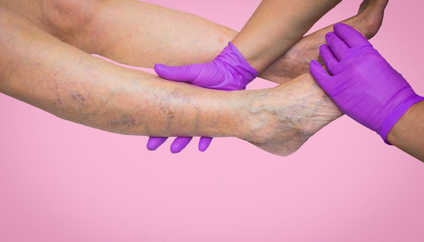 varicose veins