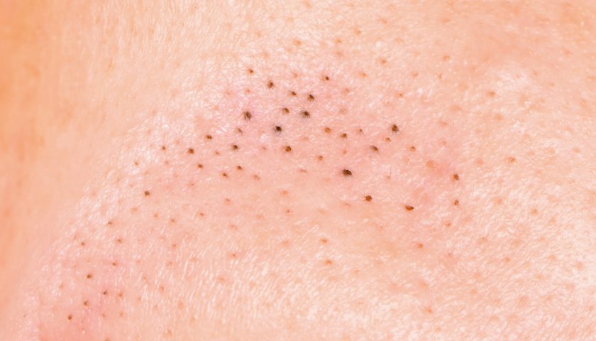 Blackheads on Breasts