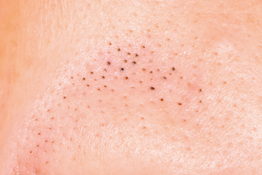 Blackheads on Breasts - Tips and Tricks to Get Rid of Blackheads on Your  Chest - Healthwire