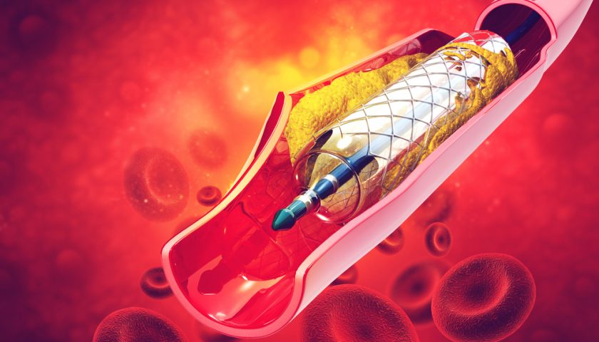 Cardiac Stent