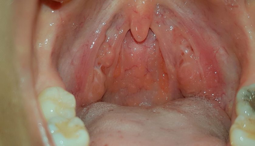 Cobblestone Throat