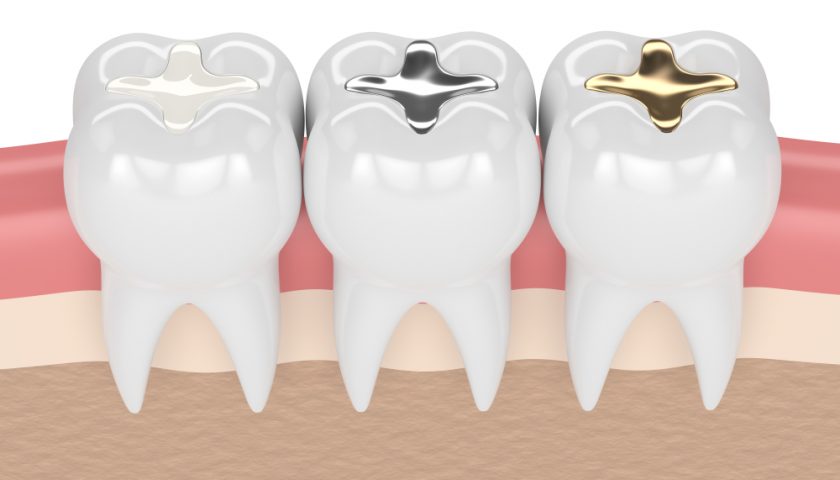 Dental Fillings
