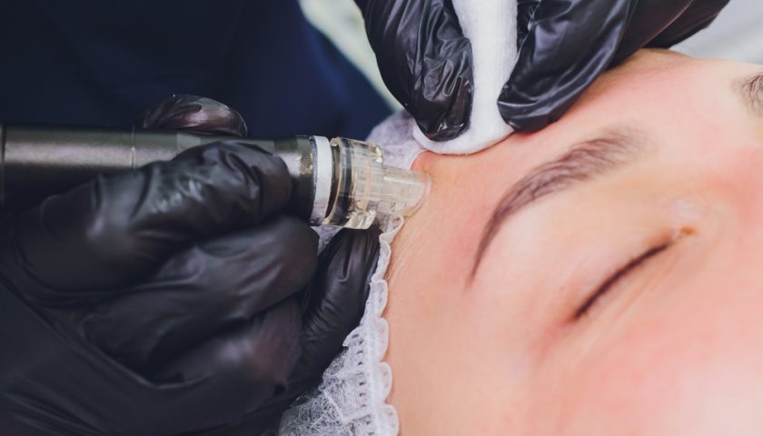 Dermabrasion Facial
