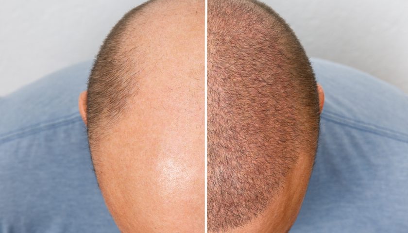 Hair-transplant