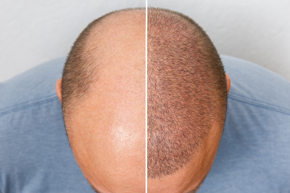 11 Potential Hair Transplant Disadvantages - Is this Beauty Trend Worth it?  - Healthwire