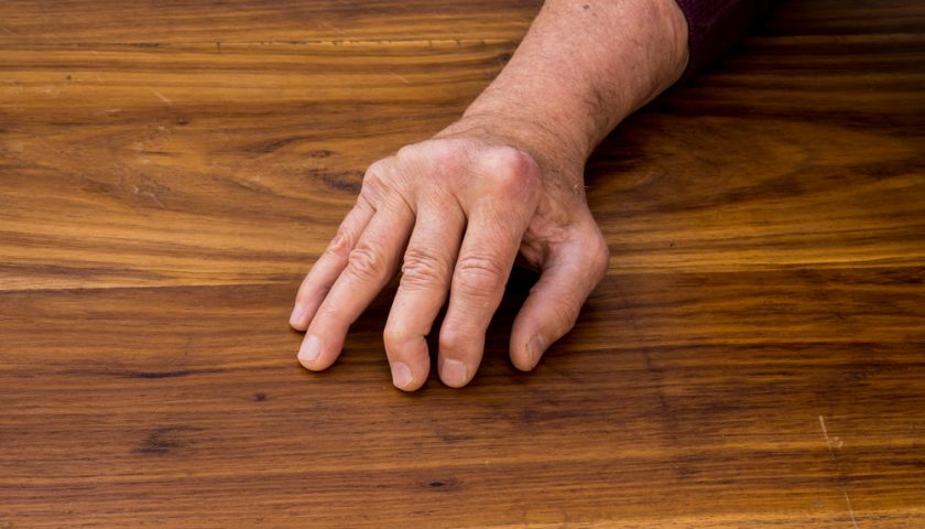How to Prevent Arthritis