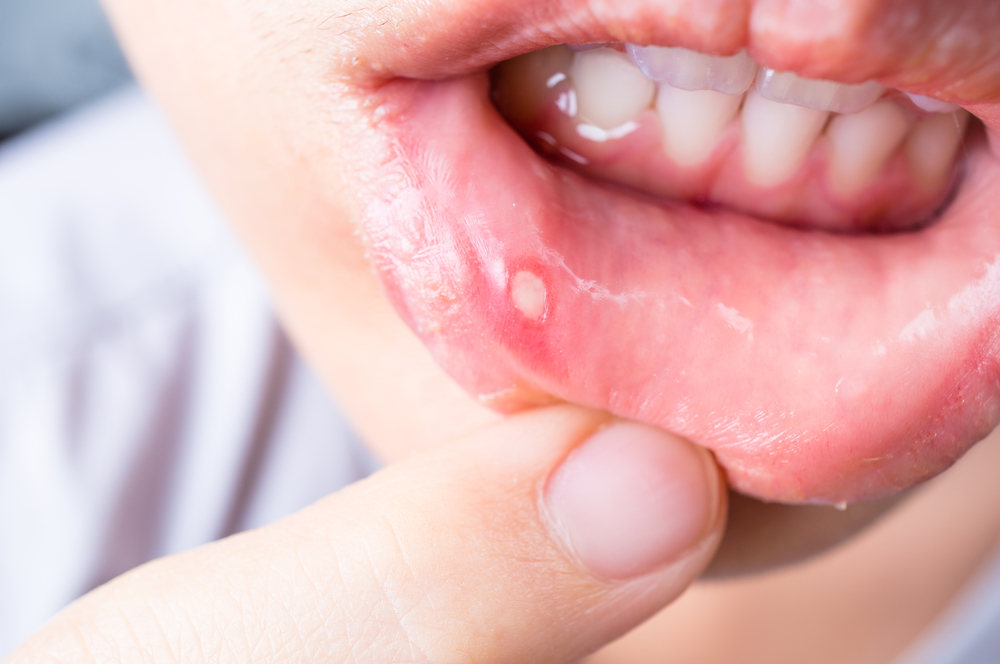 blood-blister-in-mouth-symptoms-causes-treatment-health-argue