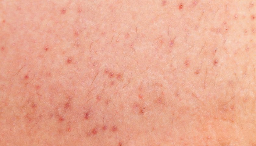 Razor Bump On Vagina