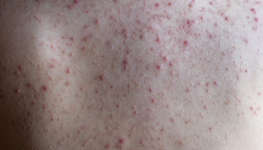 Leukemia Symptoms