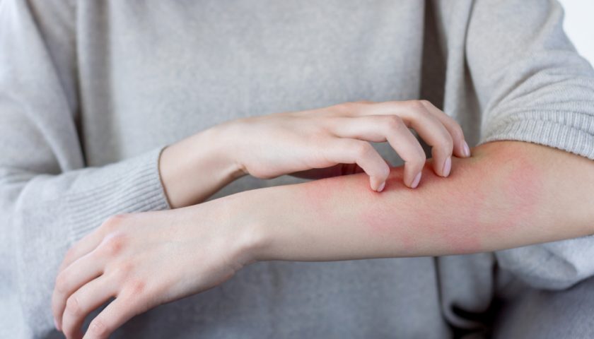 Skin Rashes