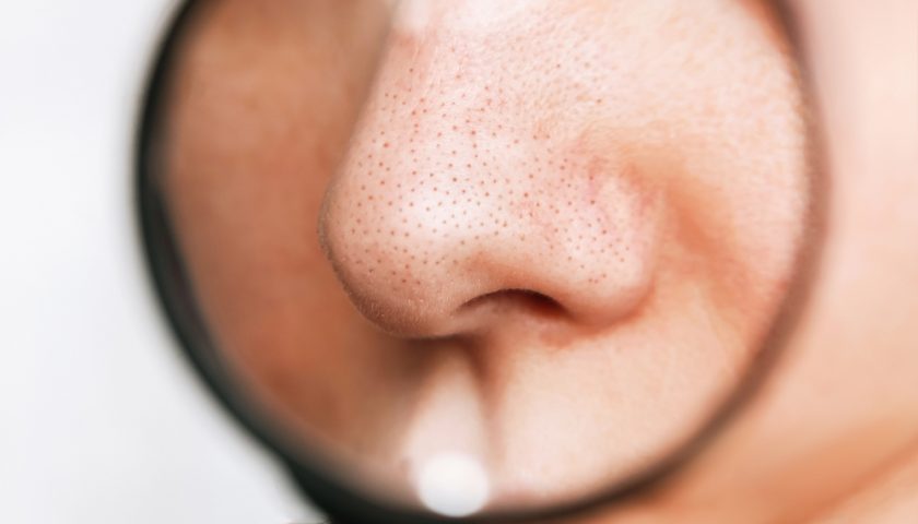 blackheads-on-nose