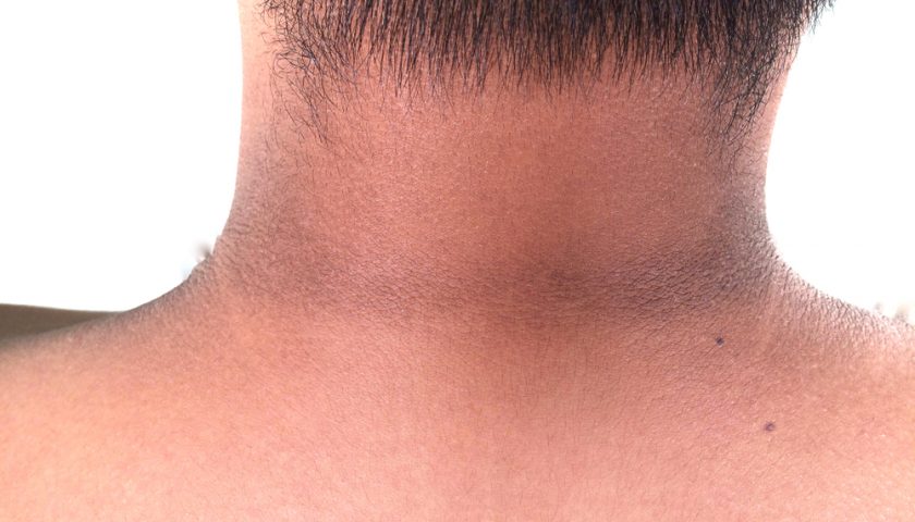 Easy Remedies For Black Neck