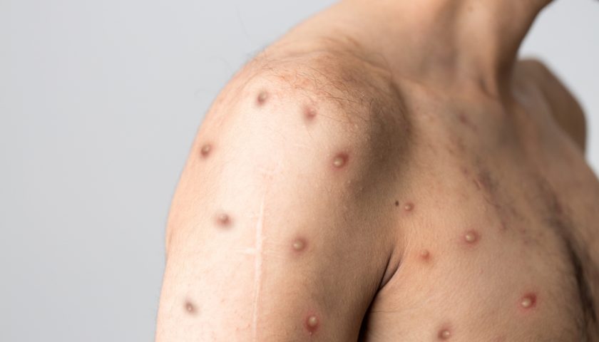 Monkeypox Virus in Pakistan 2023