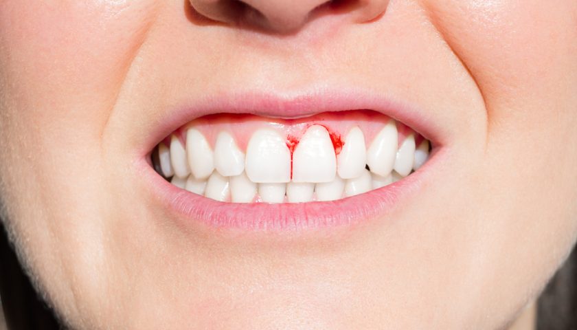 home-remedies-for-gum-bleeding-disease