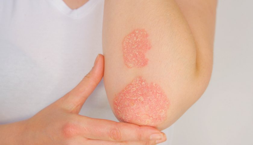Home Remedies for Psoriasis