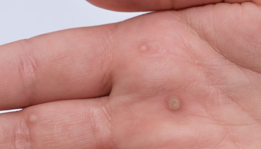 home-remedies-for-warts