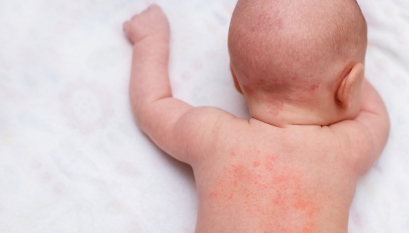 Heat Rash Baby