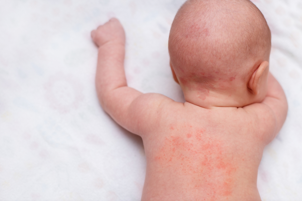 11 Extraordinary Home Remedies That Helps You To Fight With Heat Rash Baby  - Healthwire