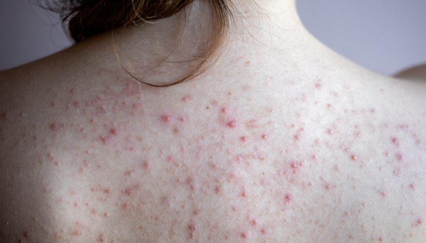 home-remedies-to-get-rid-of-acne-on-back