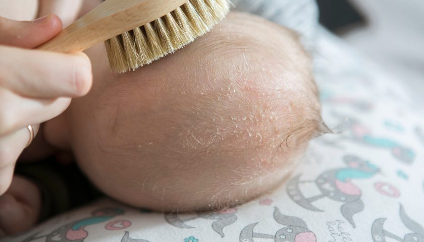 how-to-get-rid-of-baby-cradle-cap