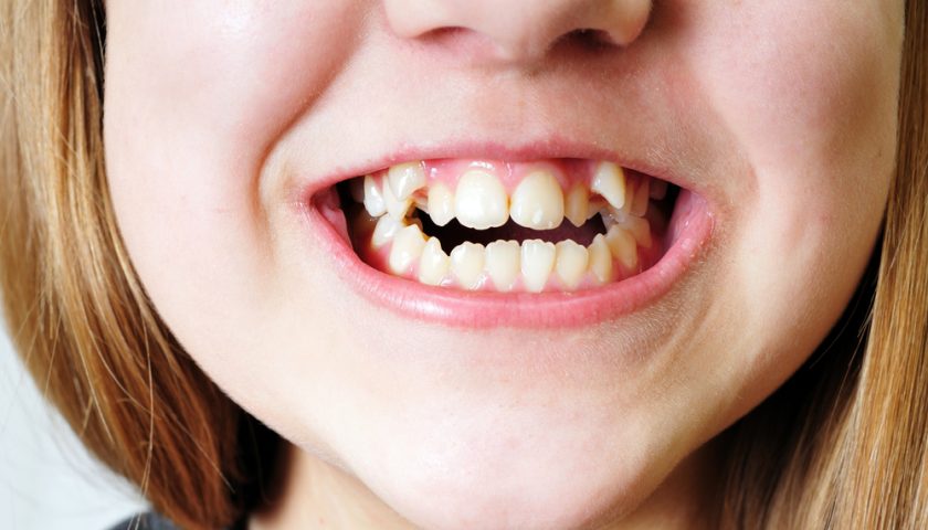 How to Protect Brittle Teeth