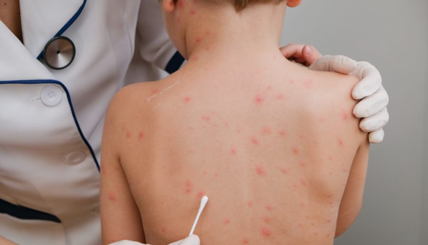 How To Remove Chicken Pox Scar