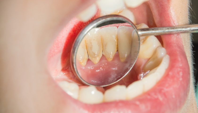 How to Remove Tartar From Teeth Without A Dentist