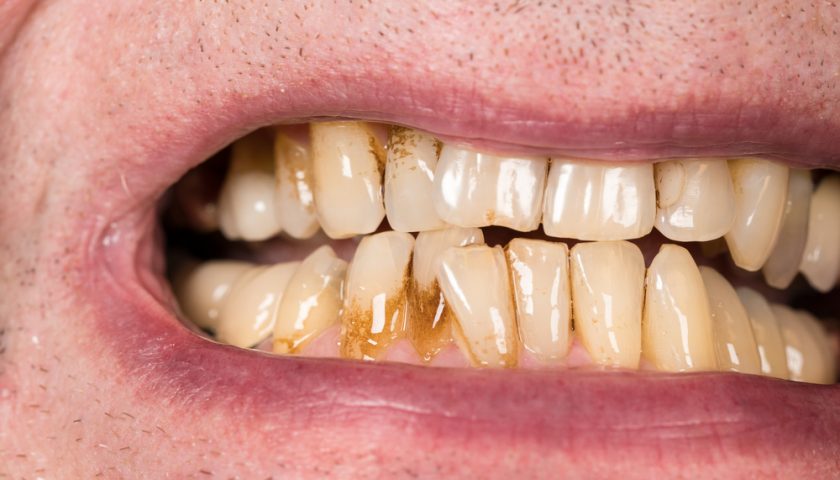 receding-gums