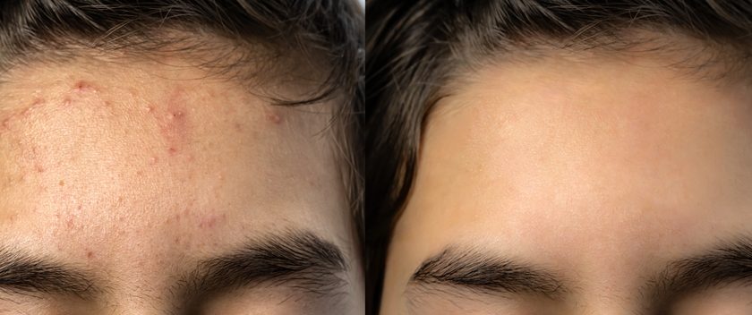 pimples-on-forhead