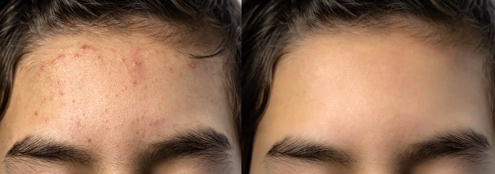 pimples on forehead causes