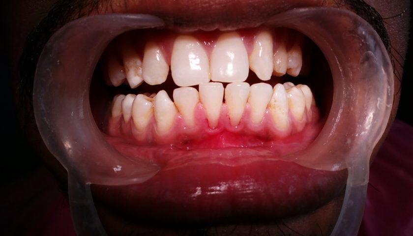 symptoms-to-look-for-gum-recession 