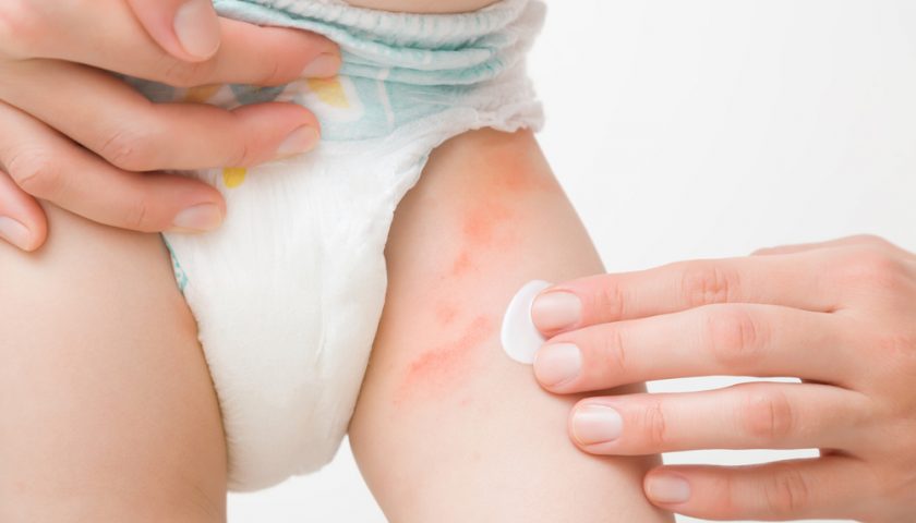 What To Do For Diaper Rash
