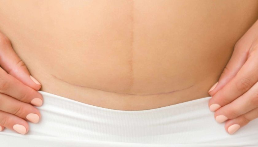 Manage Pain After C-Section