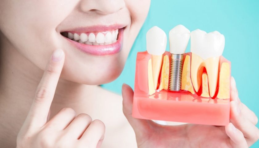 What’s A Dental Implant