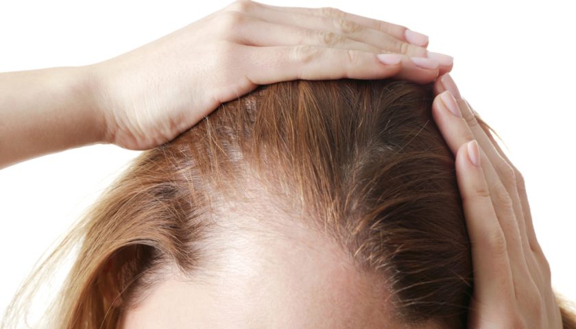 alopecia-treatment