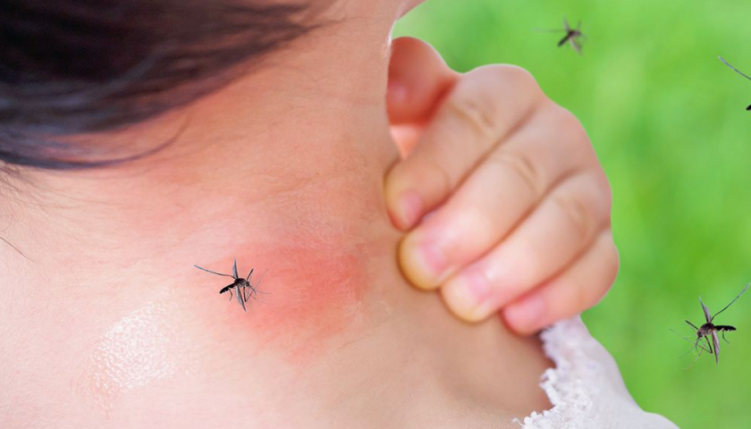home-remedies-for-bug-bites